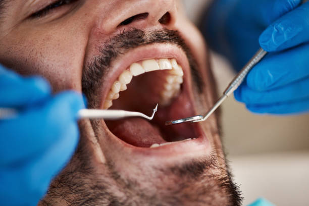 Best Emergency Wisdom Teeth Removal in Macon, GA