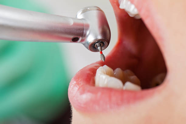 Best Emergency Broken Tooth Repair in Macon, GA